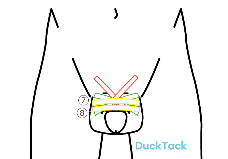 股間タック　テープで亀頭をクリトリスとして固定しているイラスト